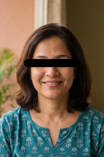 Lip & Nasolabial Lines - After