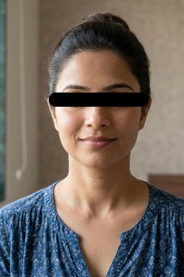 Neck & Decolletage - After