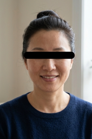 Cheeks & Midface Volume - After