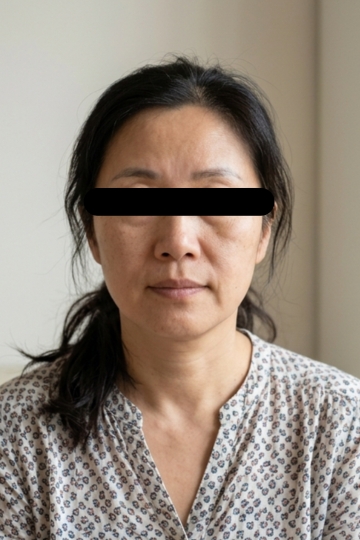 Cheeks & Midface Volume - Before