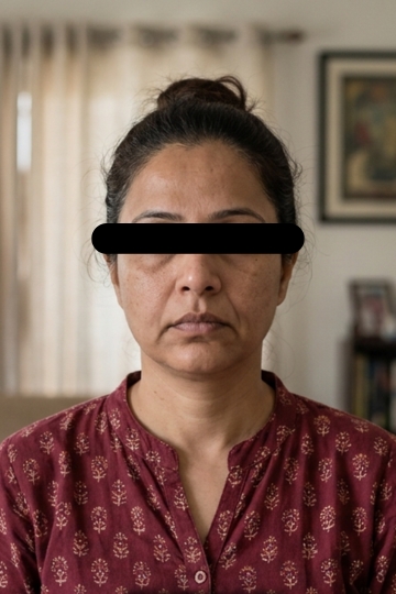 Lip & Nasolabial Lines - Before